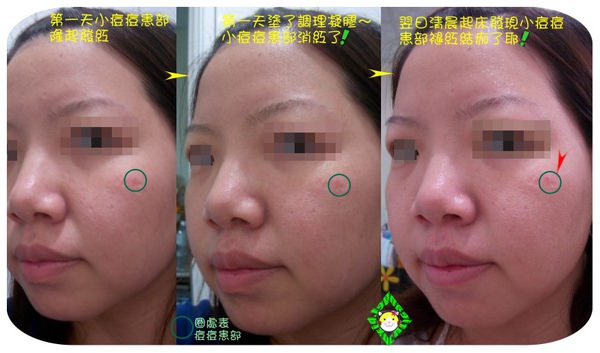 痘痘產品（側面一框）.jpg